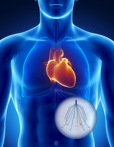 IVC Filter Injury Lawsuit Settlement Attorneys